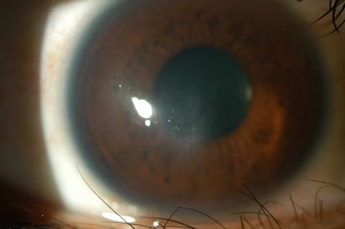 Keratoconus with corneal scarring