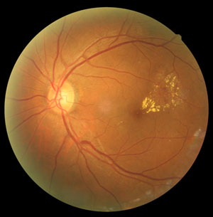 What is the Retina